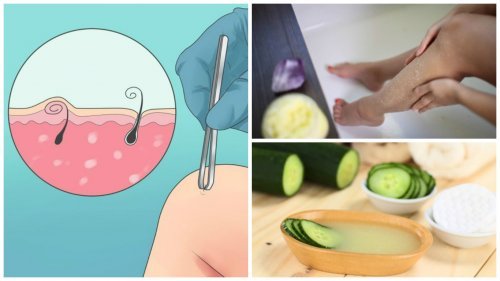 5 solutions naturelles pour éliminer les poils incarnés