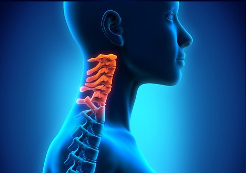 La spondylose cervicale est une forme d'arthrite.
