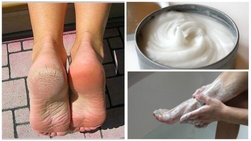 Eliminez-mycoses-et-cors-des-pieds-avec-ce-remede-naturel-500x281