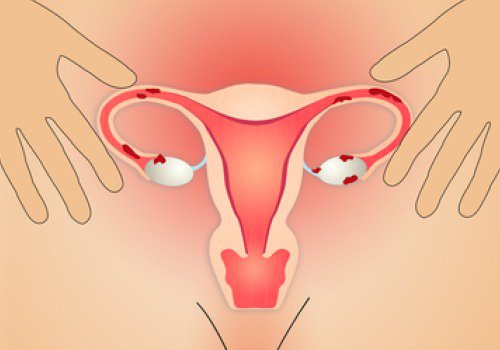 Endométriose : 5 aspects méconnus qui améliorent la qualité de vie Endométriose : 5 aspects méconnus qui améliorent la qualité de vie
