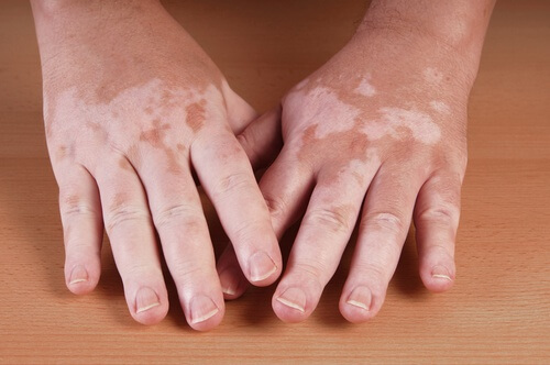 Il existe des remèdes naturels contre le vitiligo.