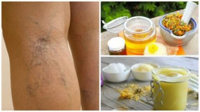 Comment préparer une pommade à l'arnica pour atténuer les varices et les araignées ?