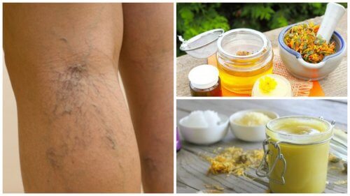 Contre les varices : l'aloe vera, la carotte et le vinaigre de pomme