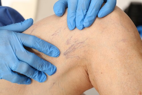 Pourquoi vous ne devriez pas porter des vêtements trop serrés : varices