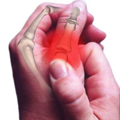 Symptômes et prévention de l’arthrose