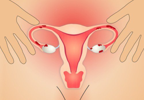 Endométriose : 5 conseils qui améliorent la qualité de vie