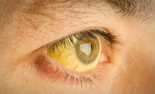 Yeux avec ictère