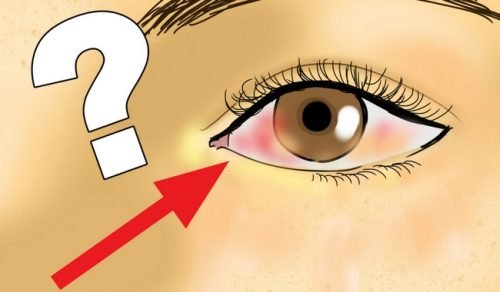 Décollement de rétine : définition, causes et prévention