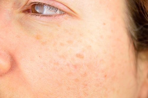 taches de vieillesse sur le visage