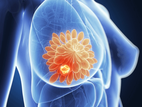 Une avancée décisive dans le dépistage du cancer du sein