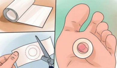 9 remèdes pour soigner les ampoules