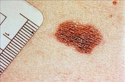 Signes de cancer de la peau à ne pas négliger