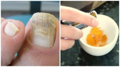 Combattez les mycoses des ongles avec un traitement naturel au curcuma