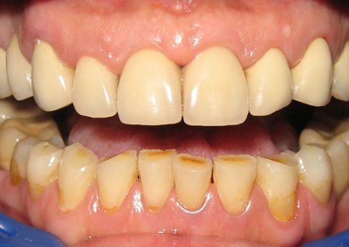 Les effets négatifs sur la dentition