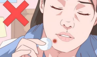 Traitement efficace et naturel pour éliminer l'acné sur le menton