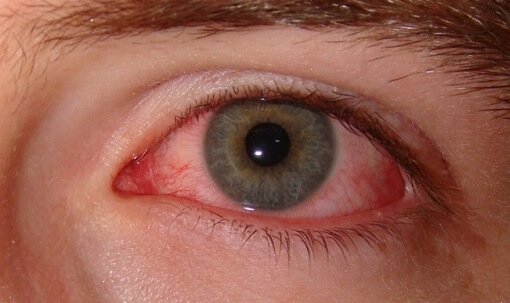rougissement oculaire