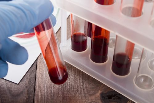 Cancer : dépistage par analyse de sang