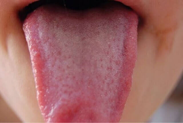 Si votre langue est rouge.