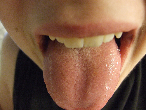 Lésions sur votre langue.