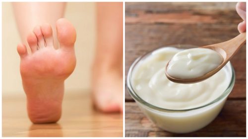 Traitement au yaourt et au vinaigre pour éliminer les callosités des pieds