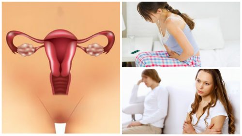 7 choses que vous devez savoir sur le syndrome de l’ovaire polykystique