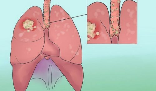 8 signes surprenants du cancer du poumon