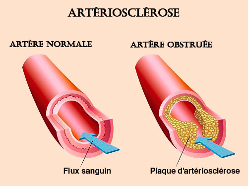 Médicament contre l'artériosclérose et le cholestérol.