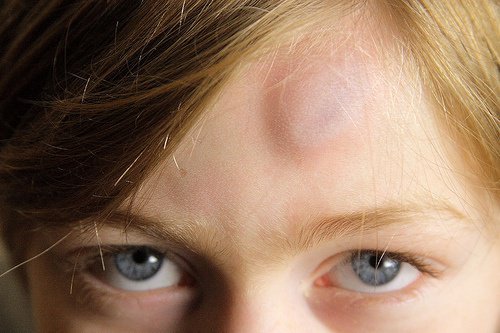9 solutions naturelles pour traiter les bleus