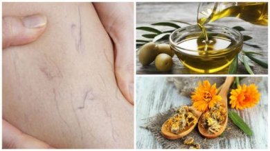 Réduire les varices avec un traitement à l’huile d’olive et calendula