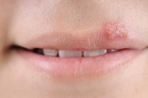 5 remèdes maison pour traiter l’herpès labial 5 remèdes maison pour traiter l’herpès labial