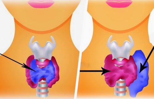 symptômes de l'hyperthyroïdie 