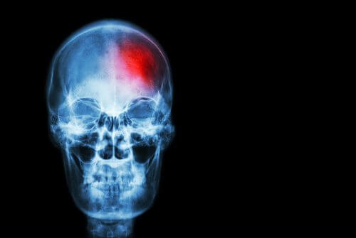 Peut-on prévenir un accident vasculaire cérébral