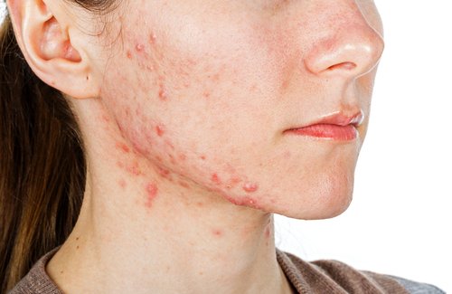 Traitements internes pour combattre l’acné