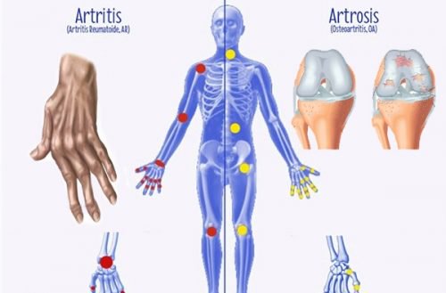 Quelques différences entre l'arthrose, l'arthrite et l'ostéoporose à connaître