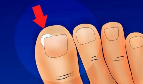 Comment éviter que nos ongles s’incarnent Comment éviter que nos ongles s’incarnent