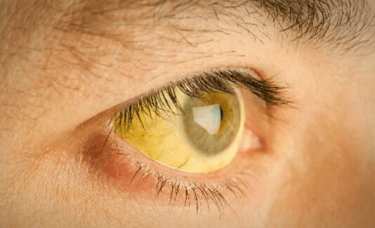 symptômes du foie chargé en toxines : jaunisse