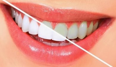 10 aliments pour blanchir les dents naturellement