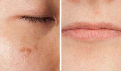 5 symptômes du manque de vitamines que l'on peut lire sur le visage