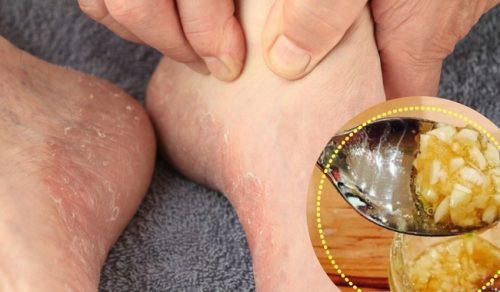 6 produits naturels qui aident le pied d'athlète