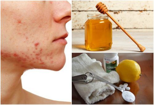 6 remèdes naturels pour faire face à l'acné kystique