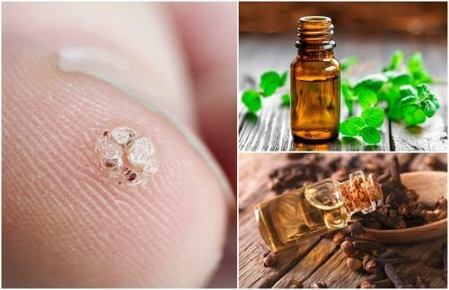 7 huiles essentielles pour combattre les verrues