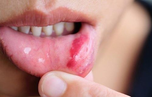 Cancer de la bouche : symptômes, facteurs à risque et prévention