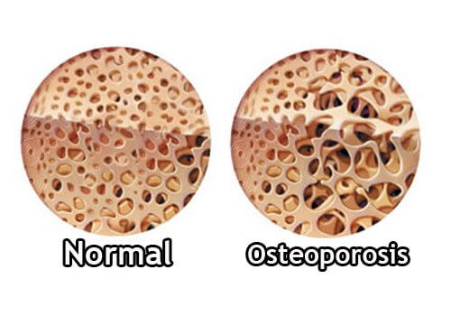 Comment contrôler l'ostéoporose pendant la ménopause
