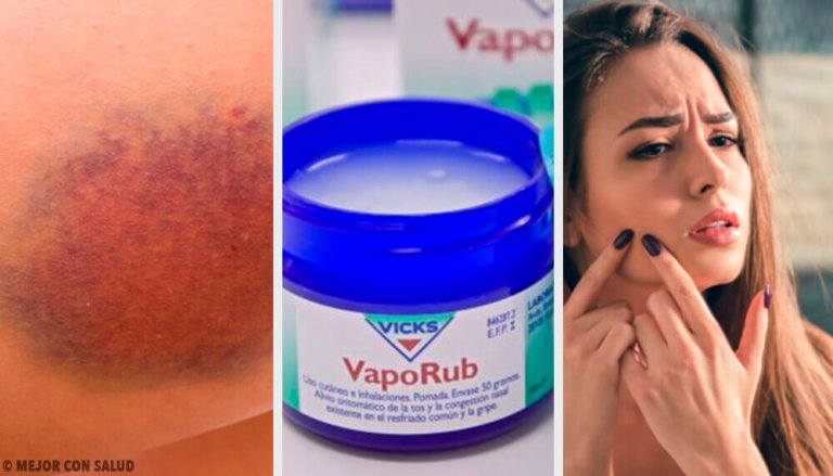 Saviez-vous que le VapoRub peut atténuer l'acné ?