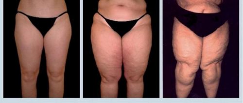 Lipœdème : une maladie difficile qu’il faut connaître Lipœdème : une maladie difficile qu’il faut connaître