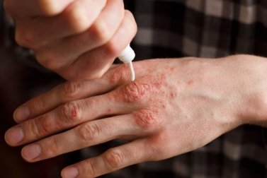 6 crèmes naturelles pour traiter le psoriasis