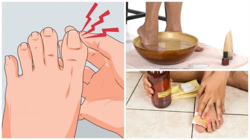 6 remèdes maison contre les ongles incarnés