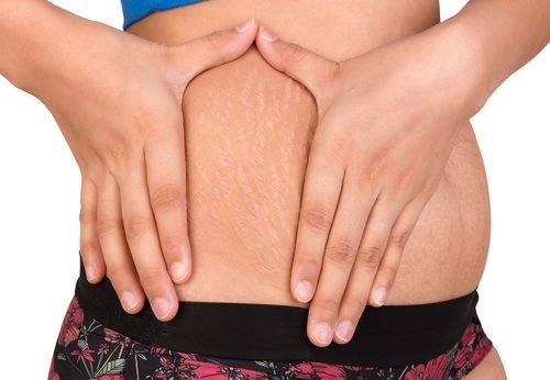 2 alternatives naturelles pour traiter les stries