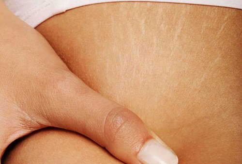 Traitements pour atténuer les vergetures sur la peau