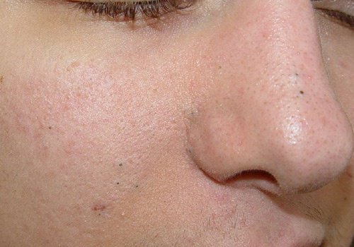 3 exfoliants maison pour éliminer les points noirs